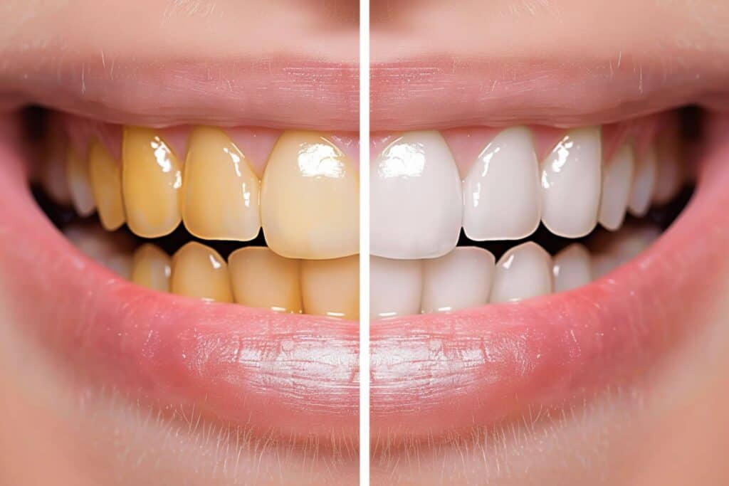 A before and after photo of teeth showing the transformation from yellowing to bright white through whitening treatment