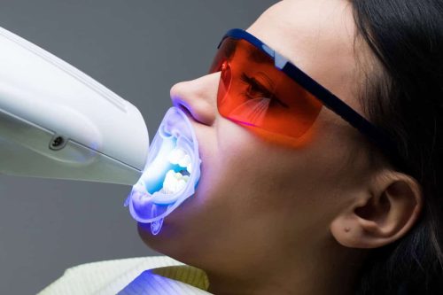 Teeth-Whitening-Naperville-Woman-Patient-Undergoing-Teeth-Whitening-
